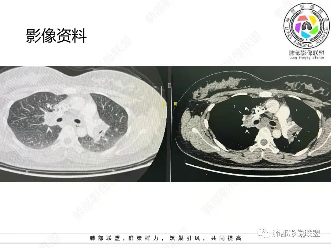 影像PPT - 【病例】肺结节病,一眼定乾坤!-10 影像PPT - 【病例】肺结节病,一眼定乾坤!-10
