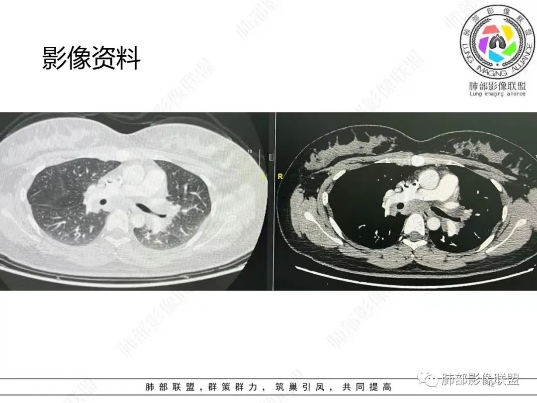 影像PPT - 【病例】肺结节病,一眼定乾坤!-12 影像PPT - 【病例】肺结节病,一眼定乾坤!-12