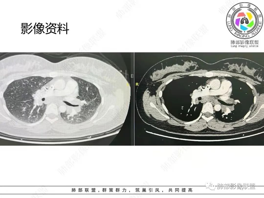 影像PPT - 【病例】肺结节病,一眼定乾坤!-13 影像PPT - 【病例】肺结节病,一眼定乾坤!-13