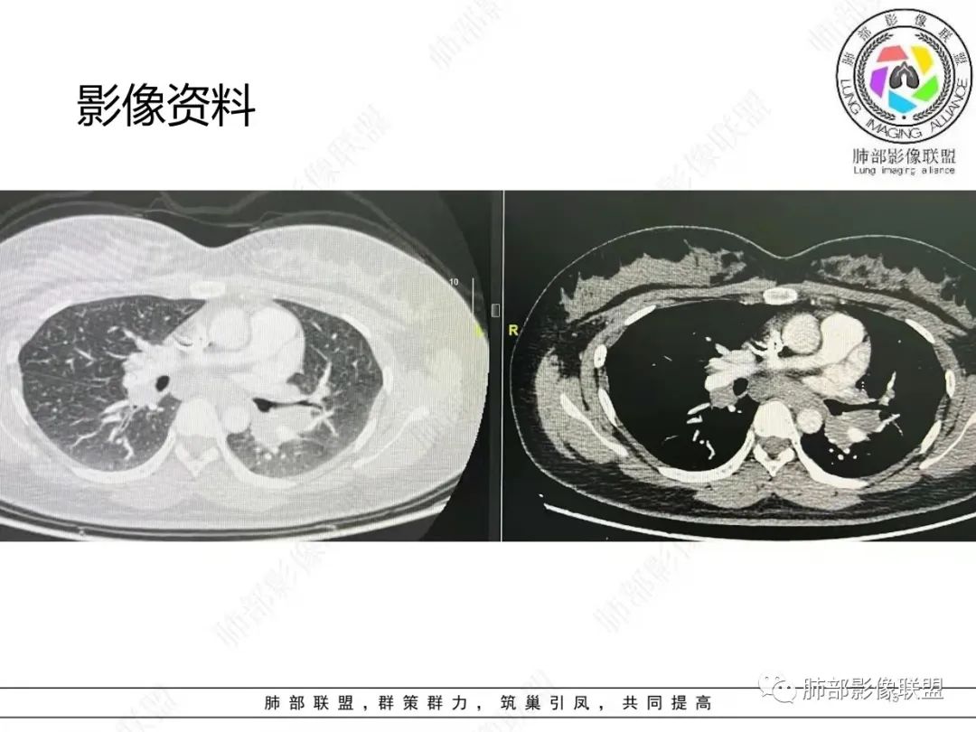 影像PPT - 【病例】肺结节病,一眼定乾坤!-15 影像PPT - 【病例】肺结节病,一眼定乾坤!-15