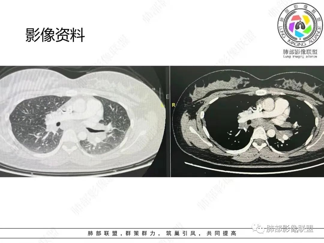 影像PPT - 【病例】肺结节病,一眼定乾坤!-14 影像PPT - 【病例】肺结节病,一眼定乾坤!-14