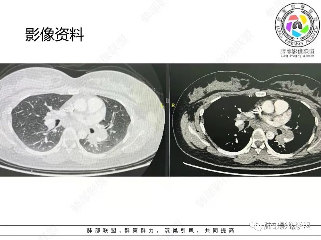 影像PPT - 【病例】肺结节病,一眼定乾坤!-16 影像PPT - 【病例】肺结节病,一眼定乾坤!-16