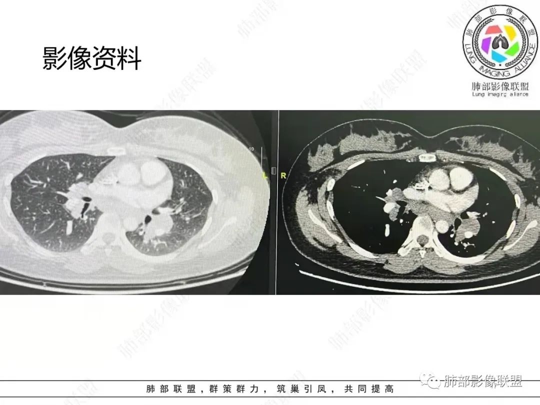 影像PPT - 【病例】肺结节病,一眼定乾坤!-17 影像PPT - 【病例】肺结节病,一眼定乾坤!-17