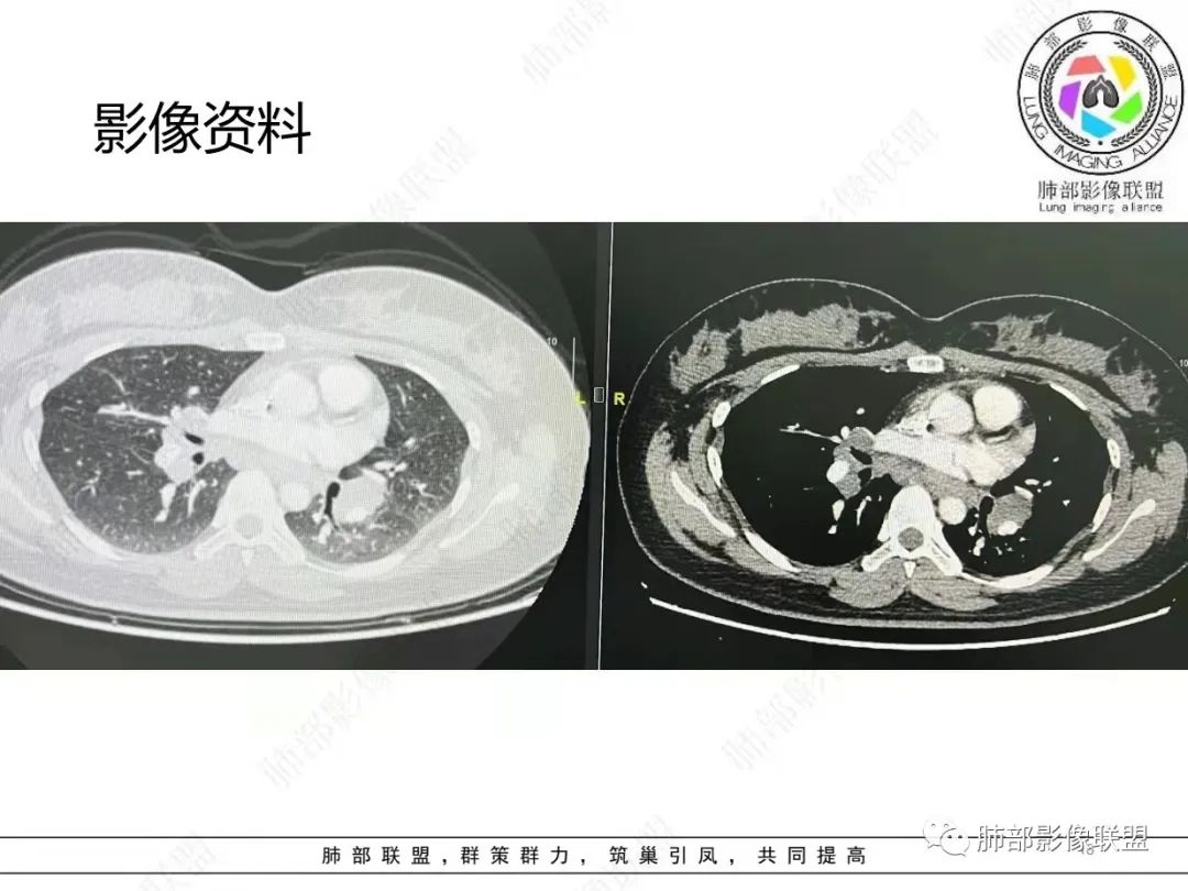 影像PPT - 【病例】肺结节病,一眼定乾坤!-18 影像PPT - 【病例】肺结节病,一眼定乾坤!-18