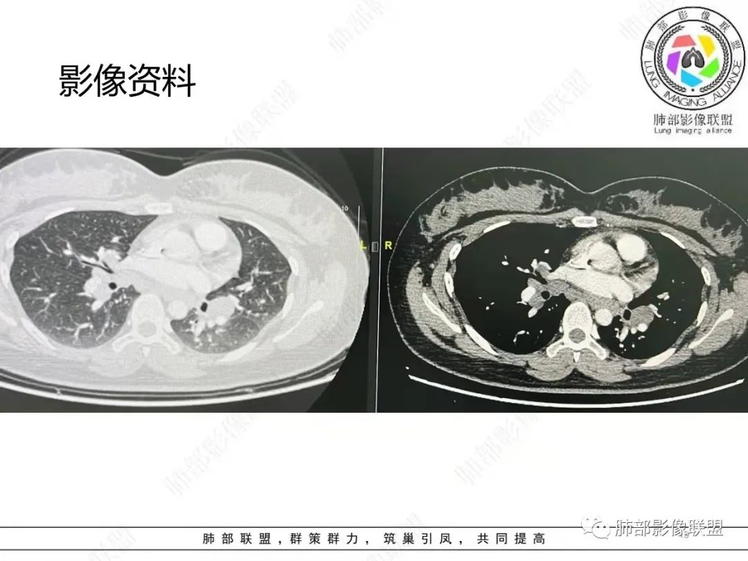 影像PPT - 【病例】肺结节病,一眼定乾坤!-19 影像PPT - 【病例】肺结节病,一眼定乾坤!-19