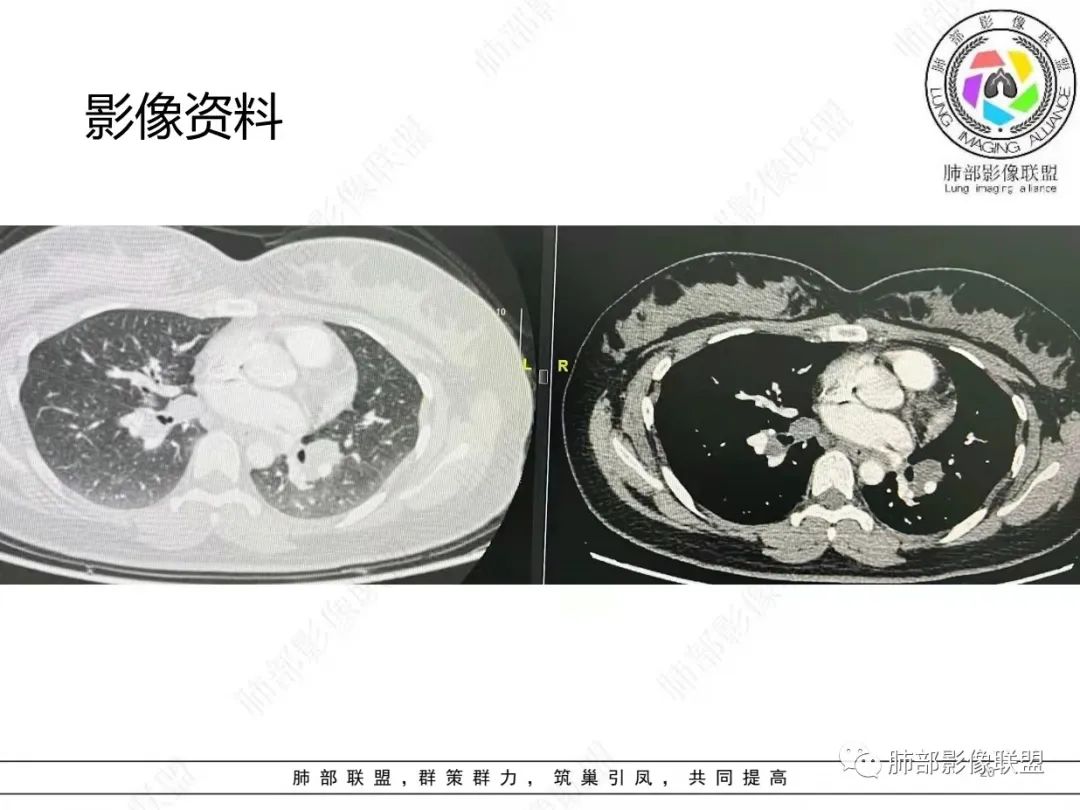 影像PPT - 【病例】肺结节病,一眼定乾坤!-20 影像PPT - 【病例】肺结节病,一眼定乾坤!-20