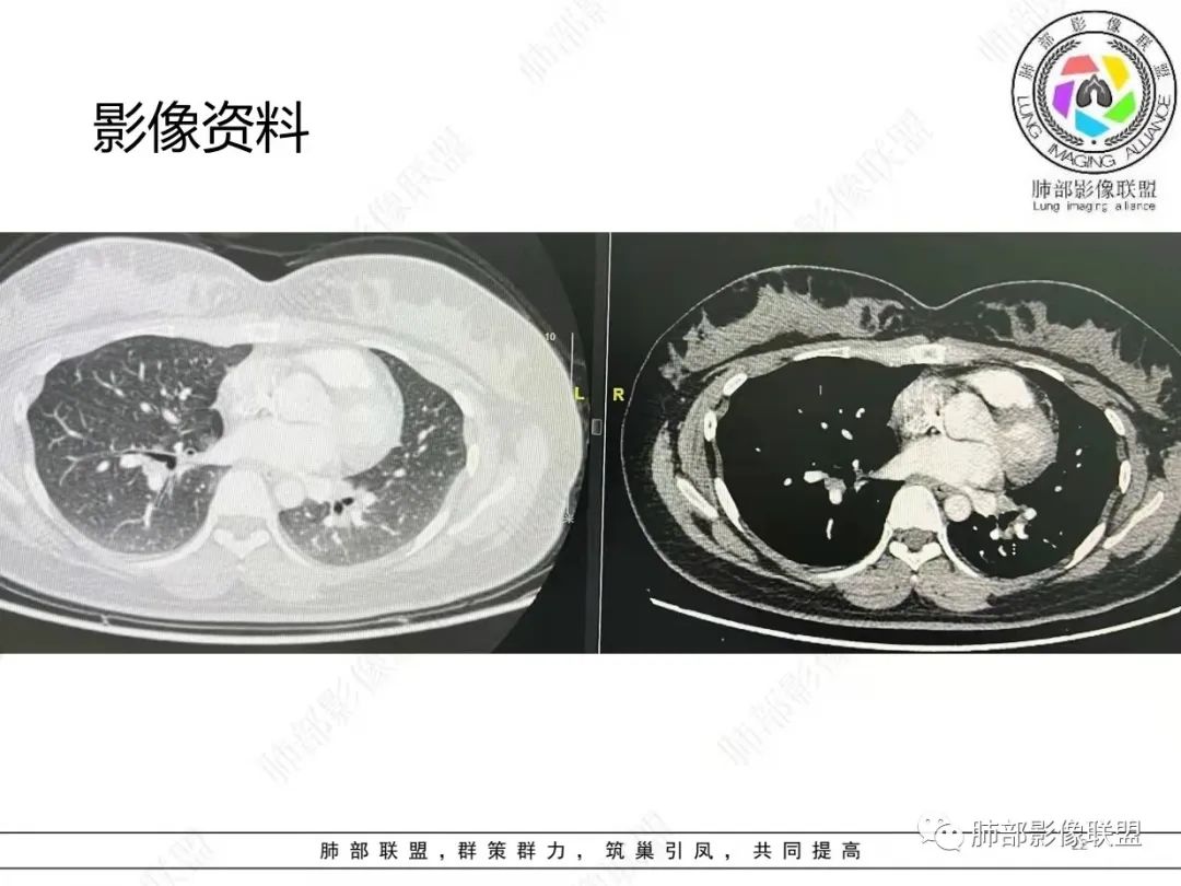 影像PPT - 【病例】肺结节病,一眼定乾坤!-22 影像PPT - 【病例】肺结节病,一眼定乾坤!-22