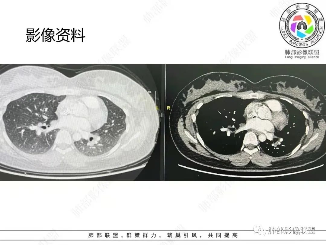影像PPT - 【病例】肺结节病,一眼定乾坤!-21 影像PPT - 【病例】肺结节病,一眼定乾坤!-21