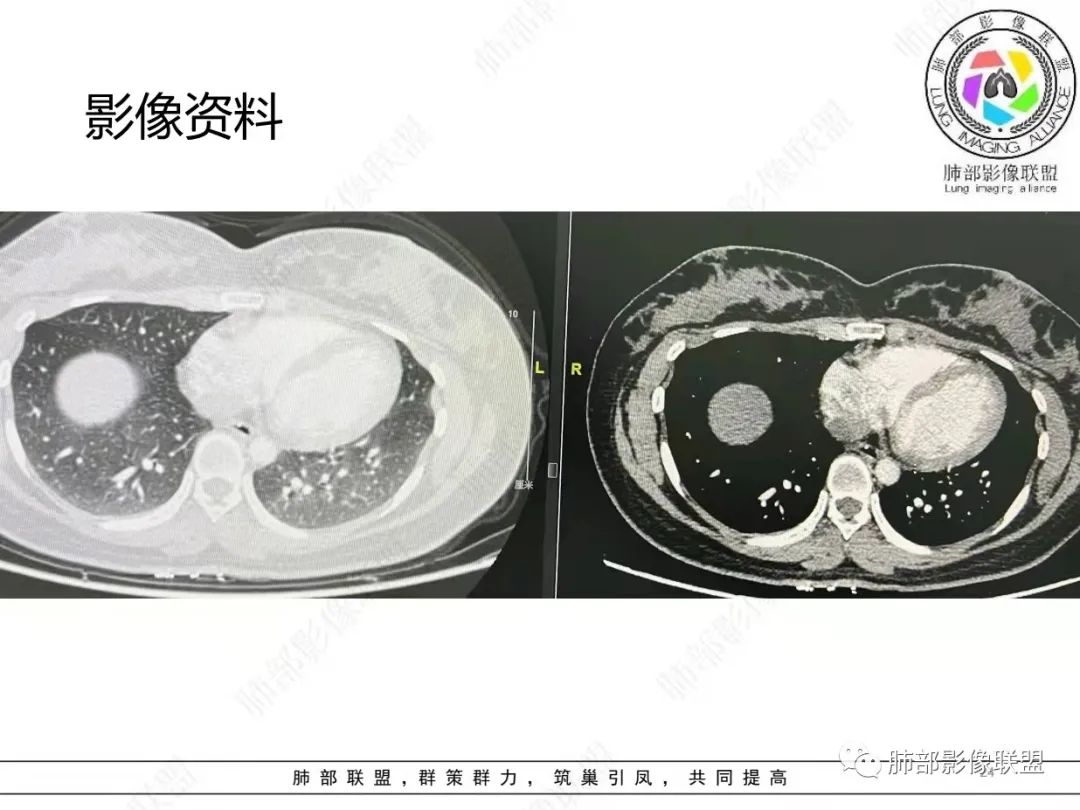 影像PPT - 【病例】肺结节病,一眼定乾坤!-24 影像PPT - 【病例】肺结节病,一眼定乾坤!-24