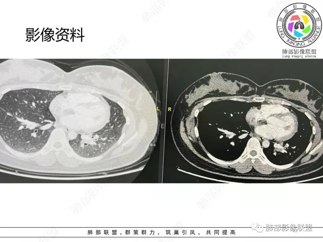 影像PPT - 【病例】肺结节病,一眼定乾坤!-23 影像PPT - 【病例】肺结节病,一眼定乾坤!-23