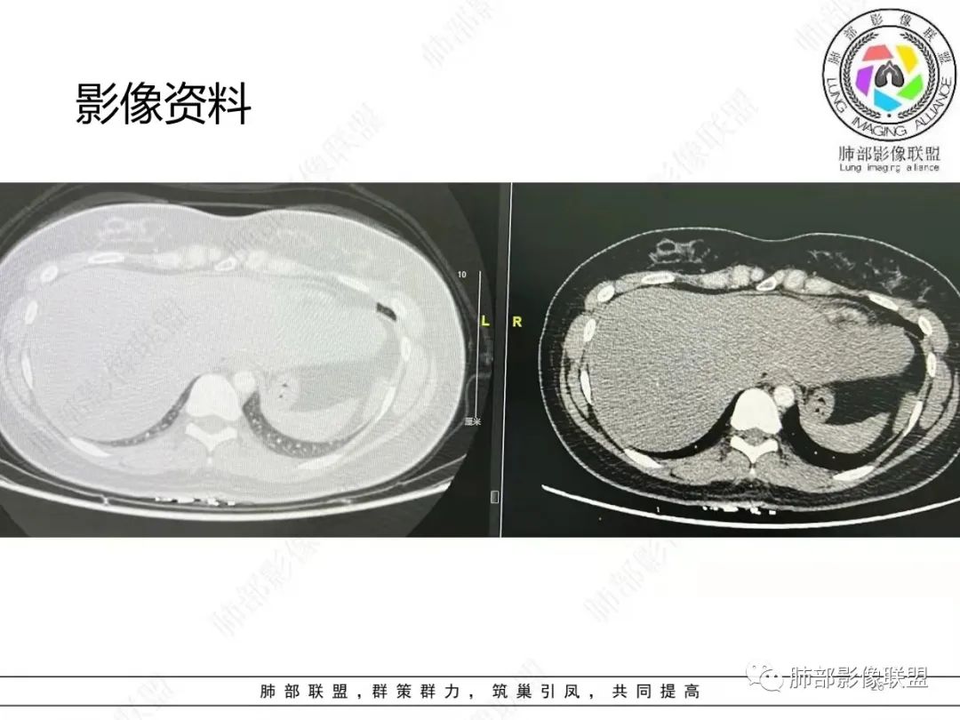 影像PPT - 【病例】肺结节病,一眼定乾坤!-26 影像PPT - 【病例】肺结节病,一眼定乾坤!-26