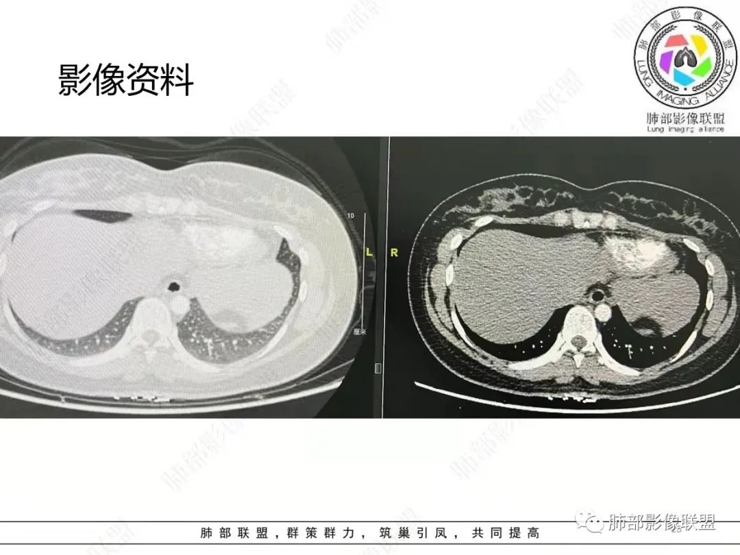 影像PPT - 【病例】肺结节病,一眼定乾坤!-25 影像PPT - 【病例】肺结节病,一眼定乾坤!-25