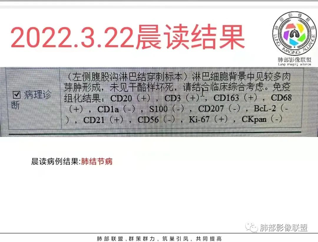 影像PPT - 【病例】肺结节病,一眼定乾坤!-36 影像PPT - 【病例】肺结节病,一眼定乾坤!-36