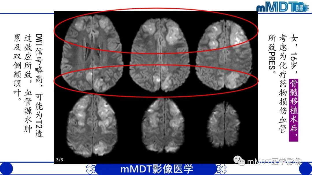 影像PPT - 【PPT】可逆性后部脑病综合征（PRES）-8