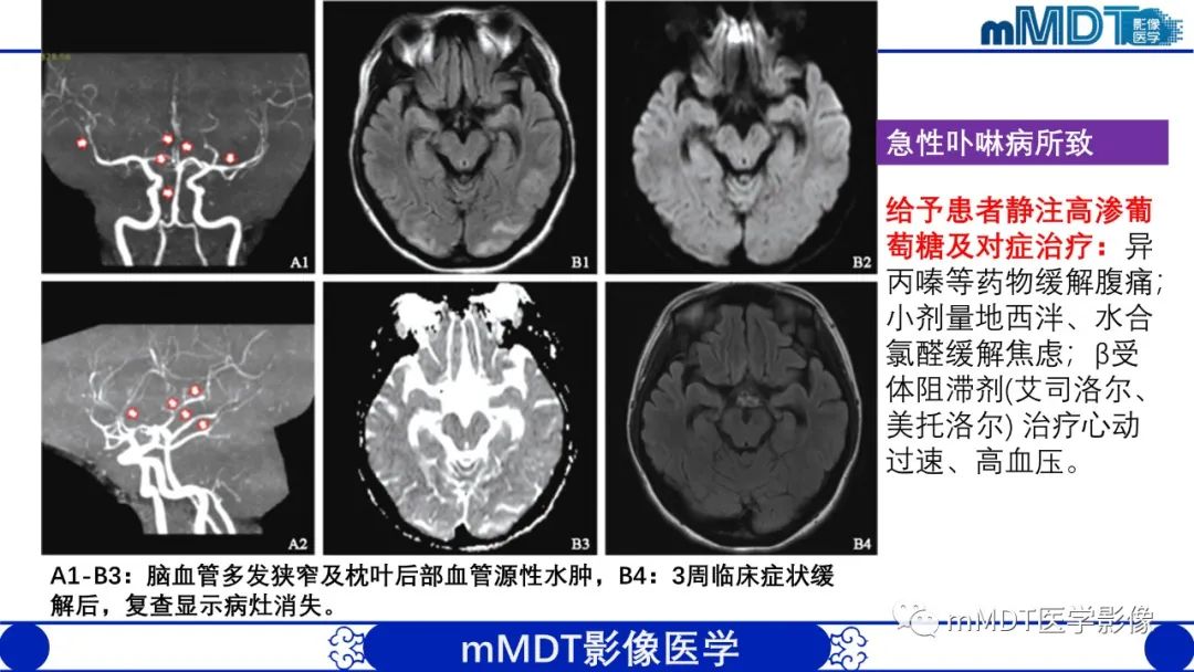 影像PPT - 【PPT】可逆性后部脑病综合征（PRES）-9