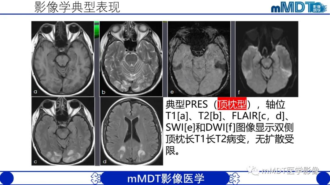 影像PPT - 【PPT】可逆性后部脑病综合征（PRES）-15