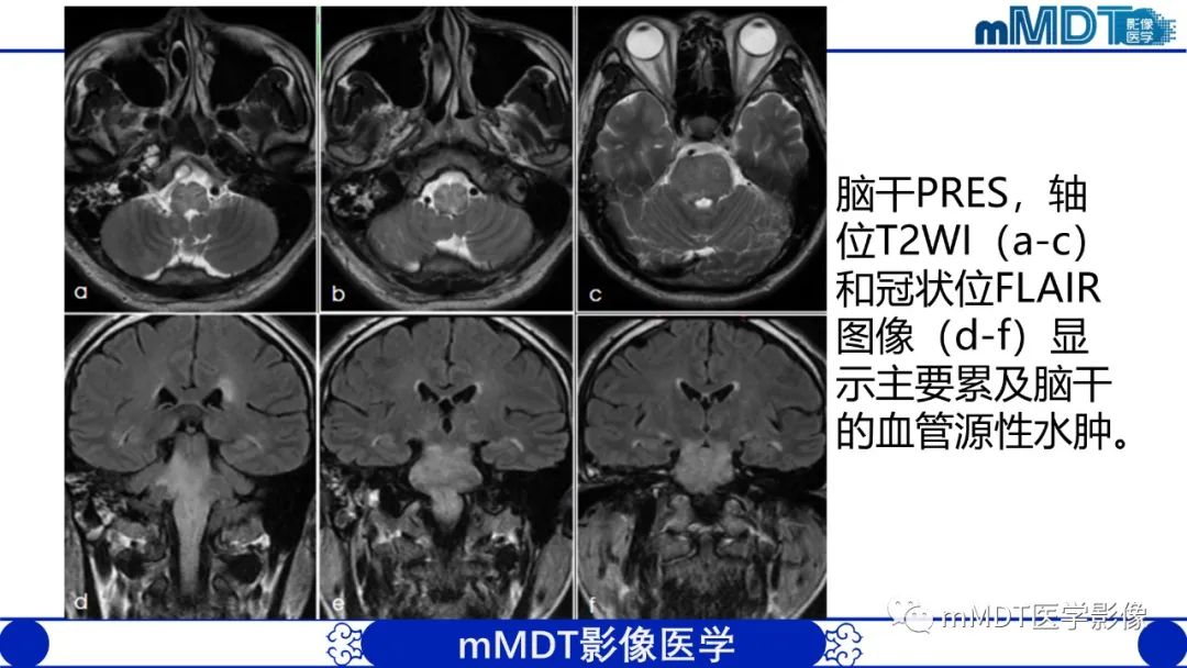 影像PPT - 【PPT】可逆性后部脑病综合征（PRES）-18