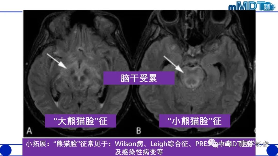 影像PPT - 【PPT】可逆性后部脑病综合征（PRES）-19