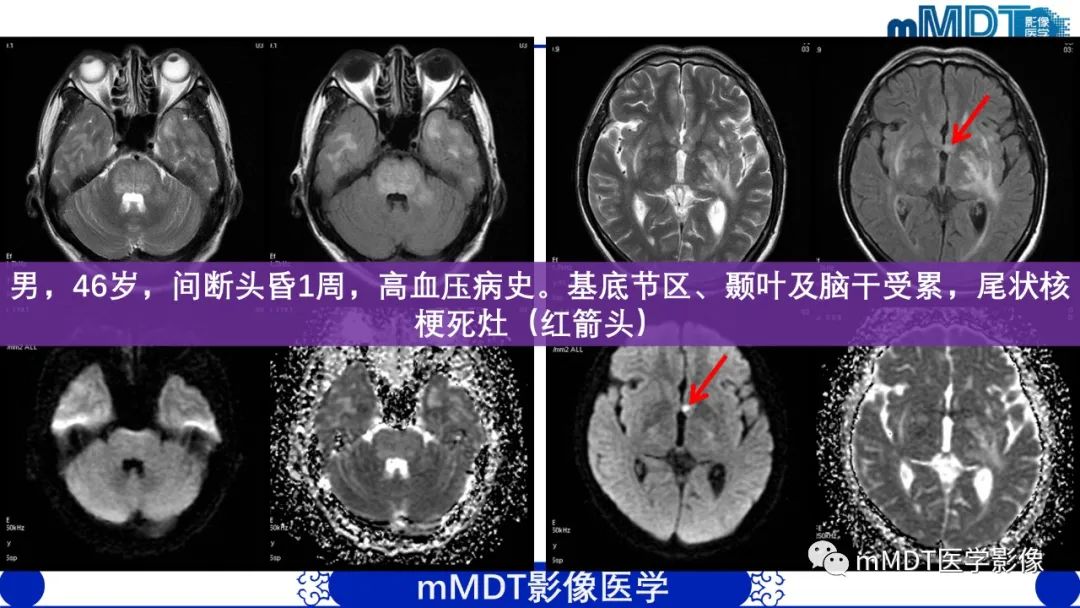 影像PPT - 【PPT】可逆性后部脑病综合征（PRES）-20