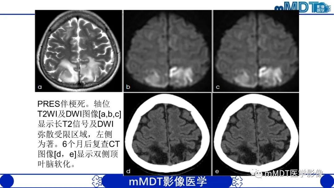 影像PPT - 【PPT】可逆性后部脑病综合征（PRES）-22