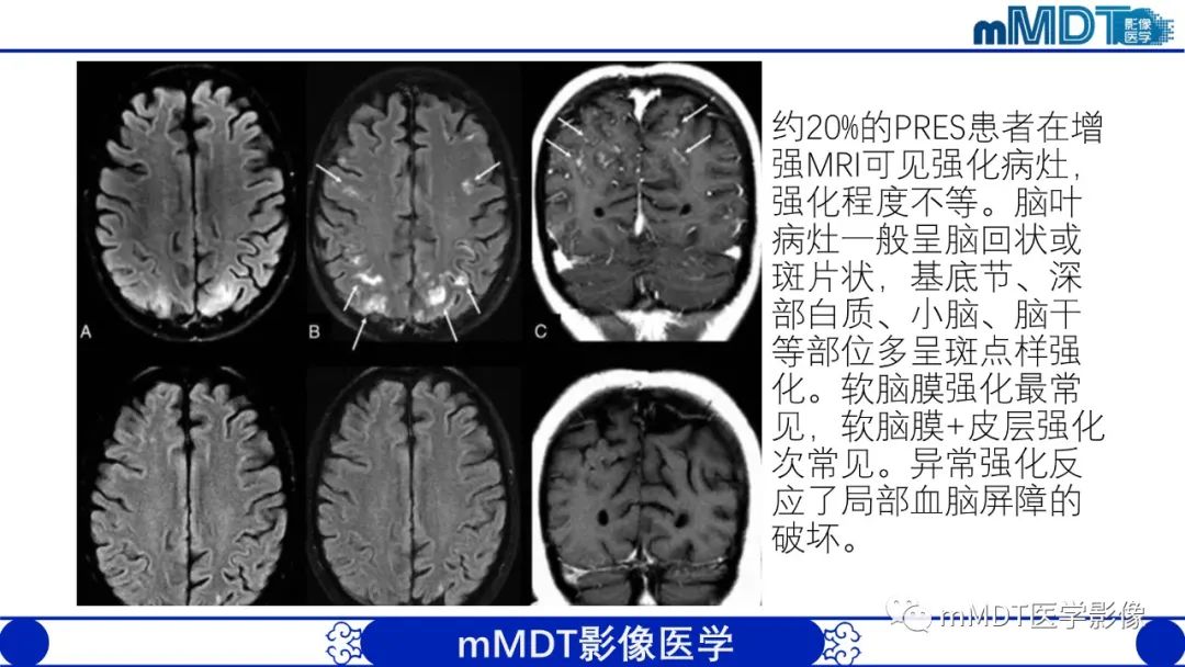影像PPT - 【PPT】可逆性后部脑病综合征（PRES）-23
