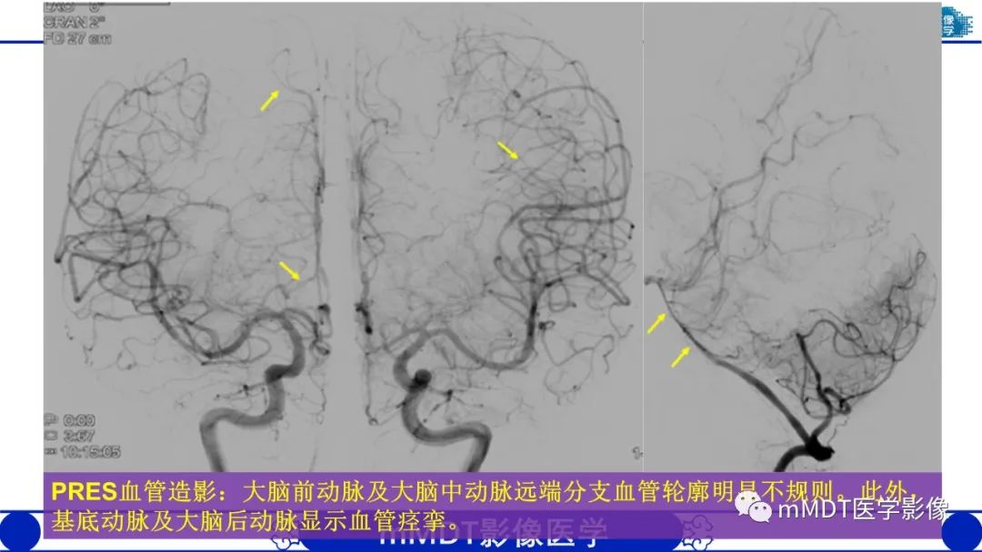 影像PPT - 【PPT】可逆性后部脑病综合征（PRES）-25