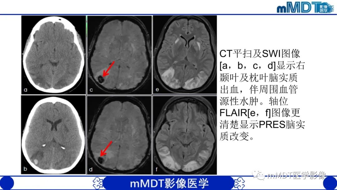 影像PPT - 【PPT】可逆性后部脑病综合征（PRES）-24
