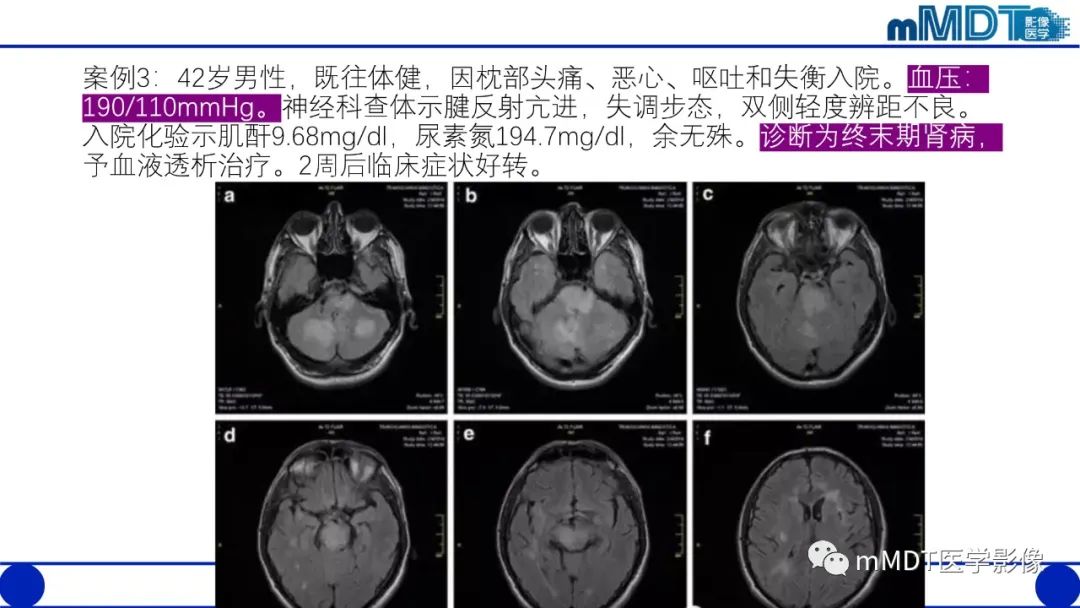 影像PPT - 【PPT】可逆性后部脑病综合征（PRES）-28