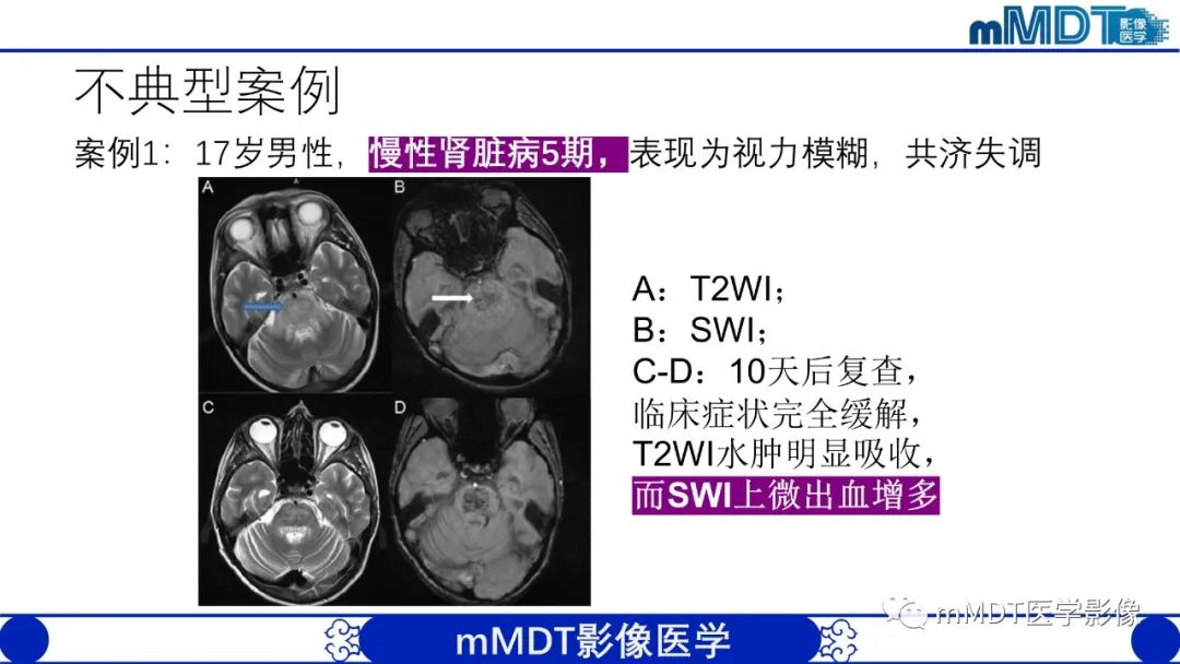 影像PPT - 【PPT】可逆性后部脑病综合征（PRES）-26