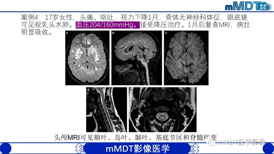 影像PPT - 【PPT】可逆性后部脑病综合征（PRES）-29