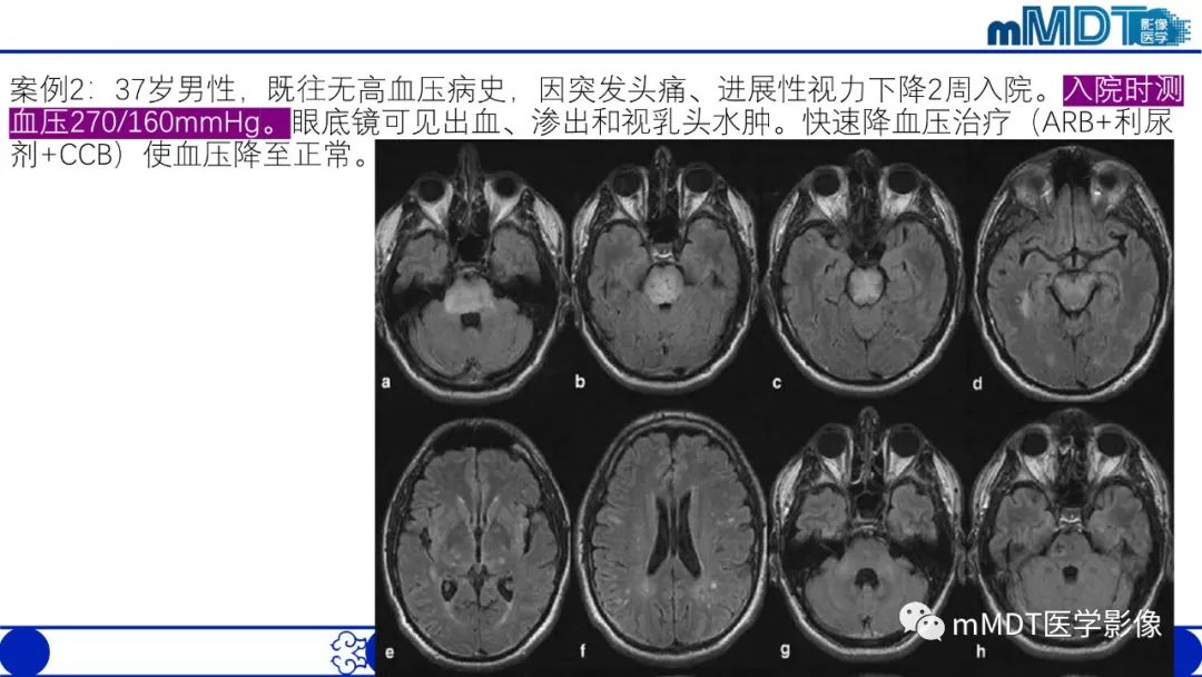 影像PPT - 【PPT】可逆性后部脑病综合征（PRES）-27