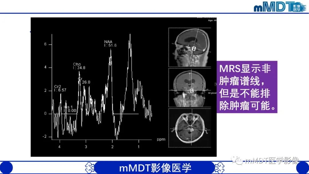 影像PPT - 【PPT】可逆性后部脑病综合征（PRES）-36