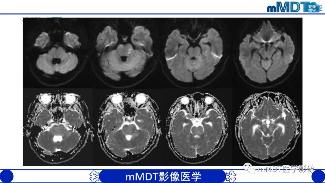 影像PPT - 【PPT】可逆性后部脑病综合征（PRES）-34