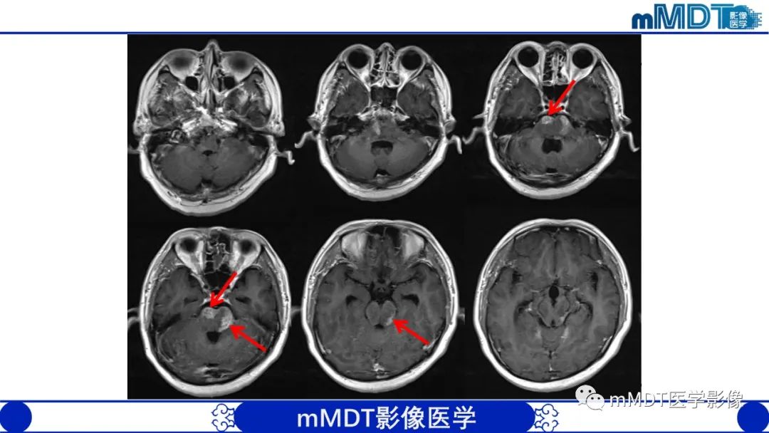 影像PPT - 【PPT】可逆性后部脑病综合征（PRES）-37