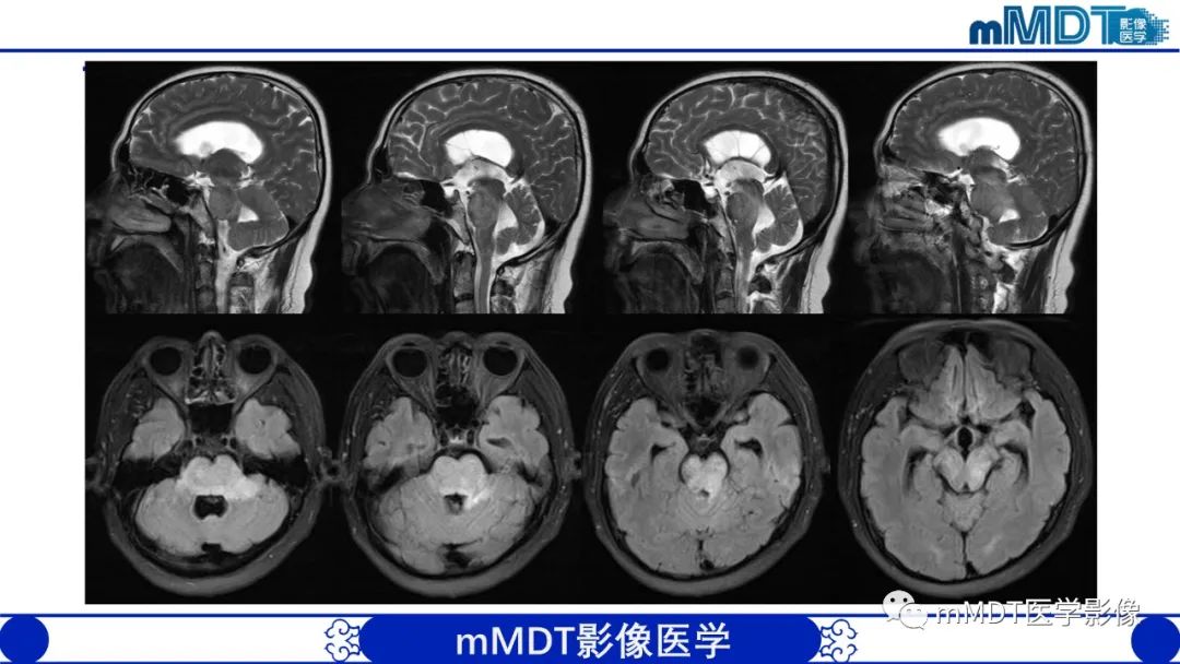 影像PPT - 【PPT】可逆性后部脑病综合征（PRES）-35