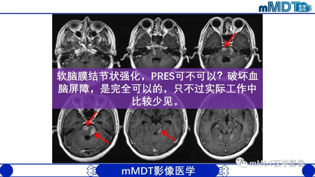 影像PPT - 【PPT】可逆性后部脑病综合征（PRES）-38