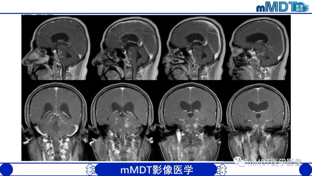 影像PPT - 【PPT】可逆性后部脑病综合征（PRES）-39