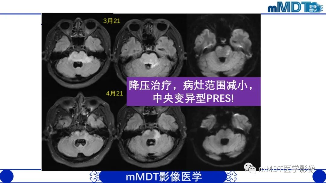 影像PPT - 【PPT】可逆性后部脑病综合征（PRES）-41