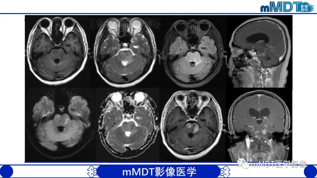 影像PPT - 【PPT】可逆性后部脑病综合征（PRES）-40