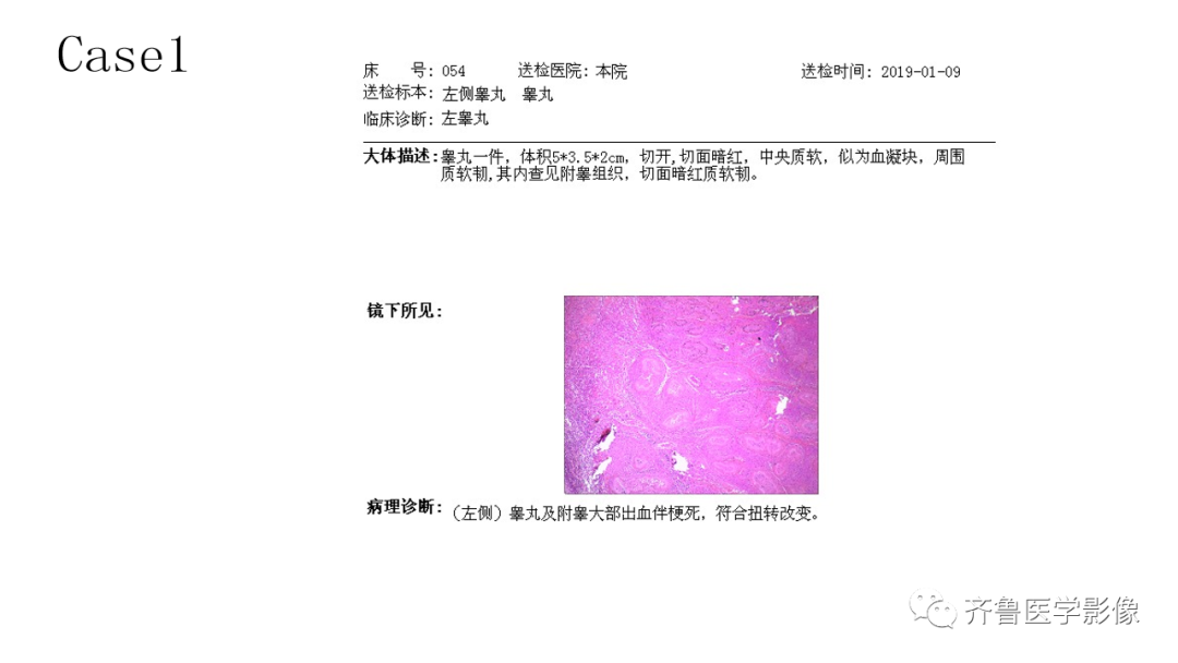 影像PPT - 【PPT】男性生殖系统疾病（睾丸扭转）-8