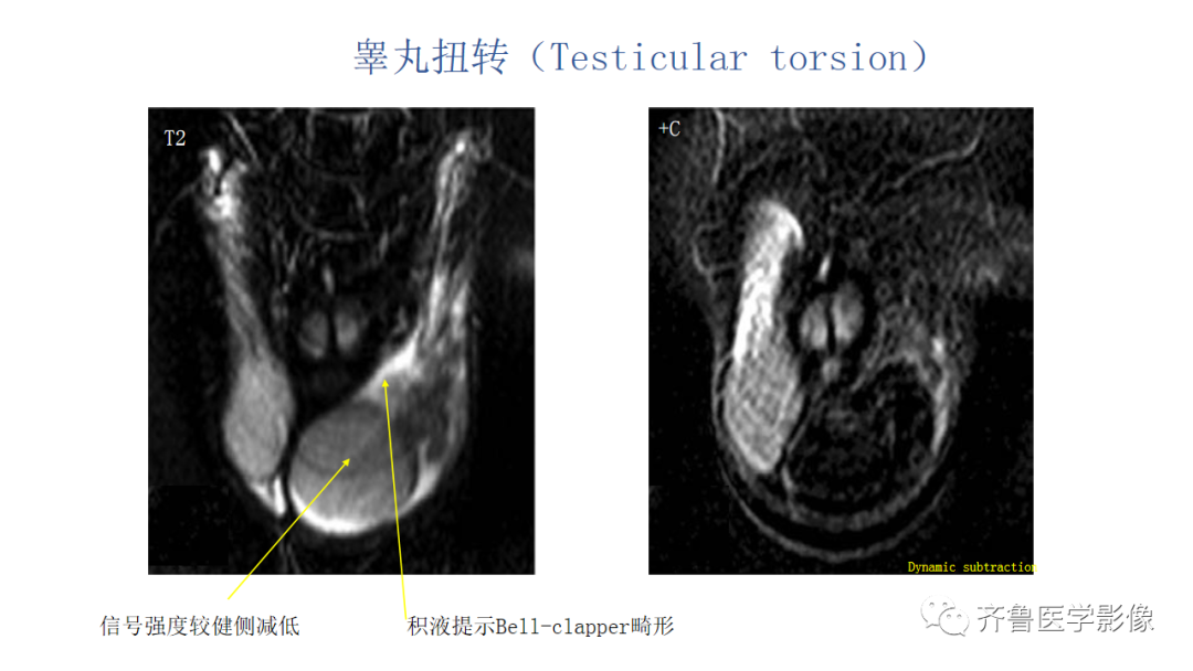 影像PPT - 【PPT】男性生殖系统疾病（睾丸扭转）-22