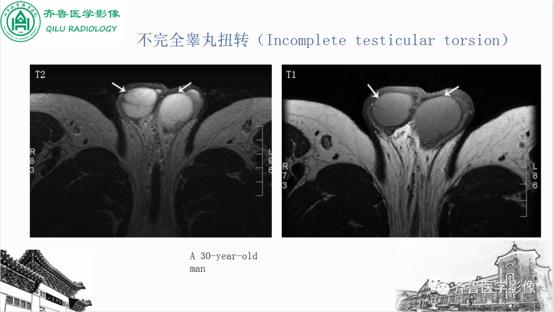 影像PPT - 【PPT】男性生殖系统疾病（睾丸扭转）-23