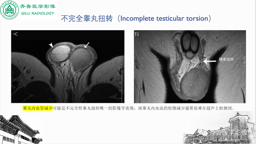 影像PPT - 【PPT】男性生殖系统疾病（睾丸扭转）-24