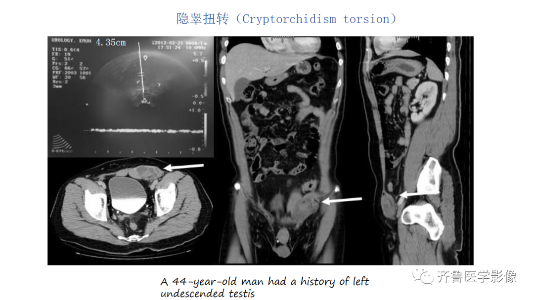 影像PPT - 【PPT】男性生殖系统疾病（睾丸扭转）-25