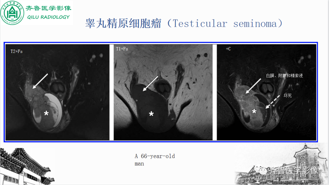 影像PPT - 【PPT】男性生殖系统疾病（睾丸扭转）-28