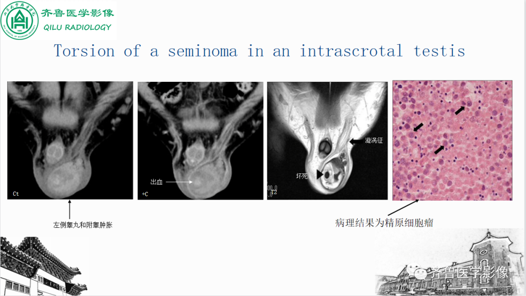 影像PPT - 【PPT】男性生殖系统疾病（睾丸扭转）-29