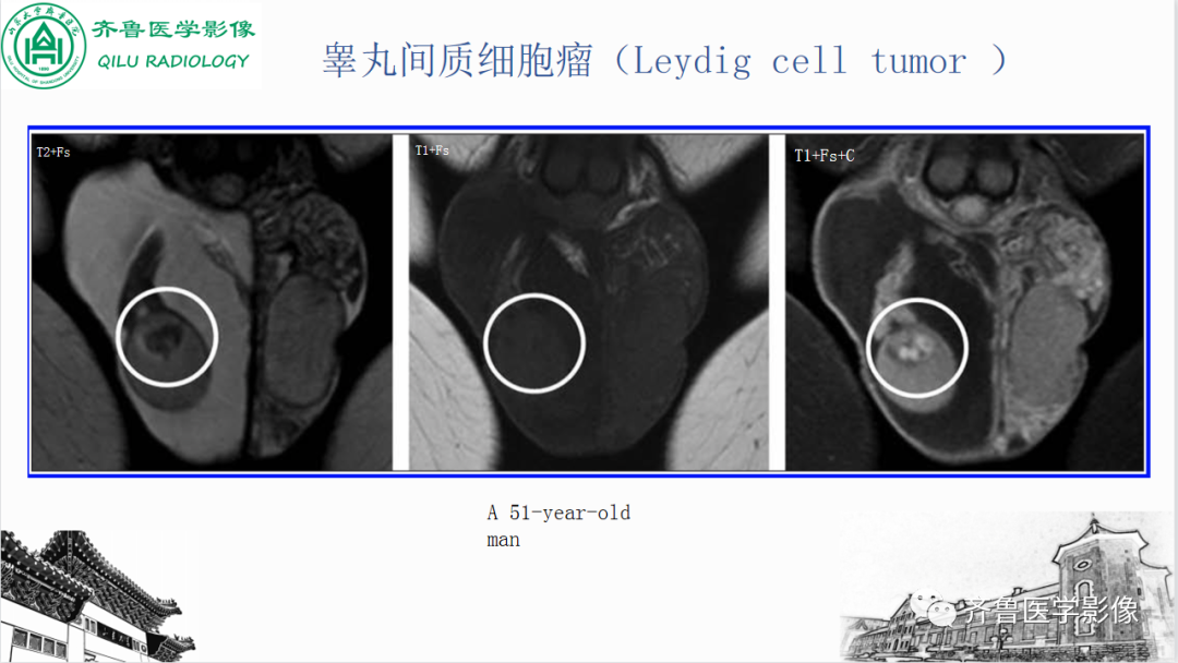 影像PPT - 【PPT】男性生殖系统疾病（睾丸扭转）-37