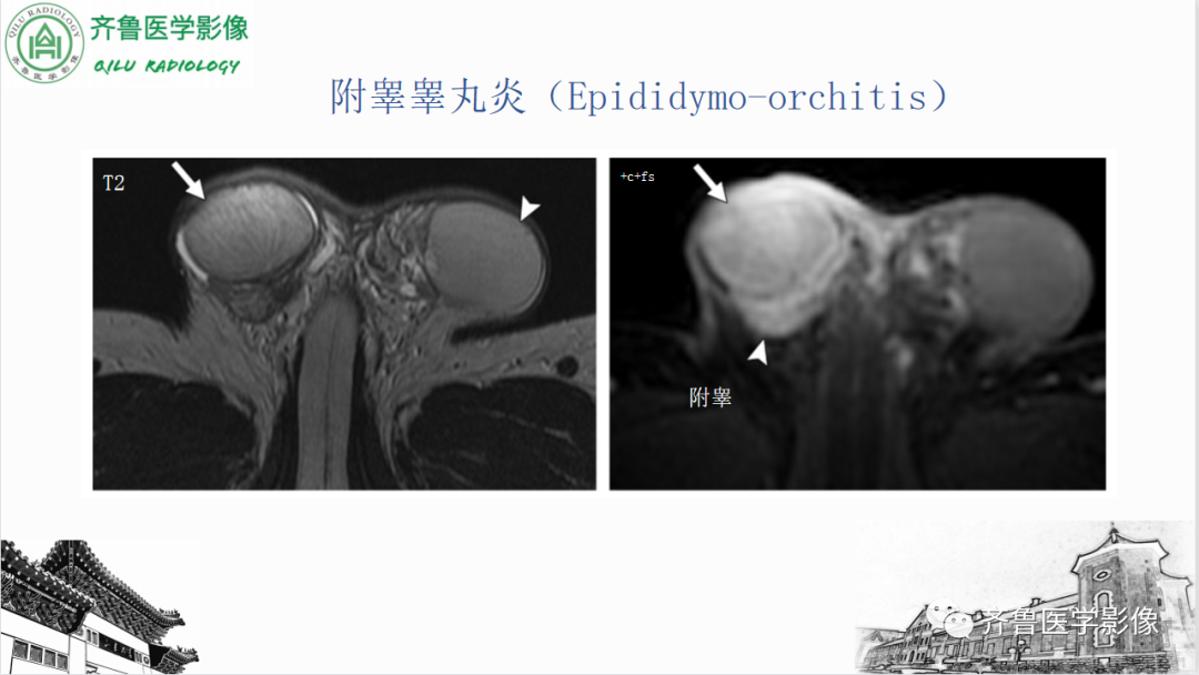 影像PPT - 【PPT】男性生殖系统疾病（睾丸扭转）-32