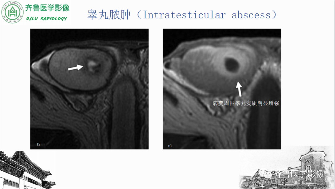 影像PPT - 【PPT】男性生殖系统疾病（睾丸扭转）-35