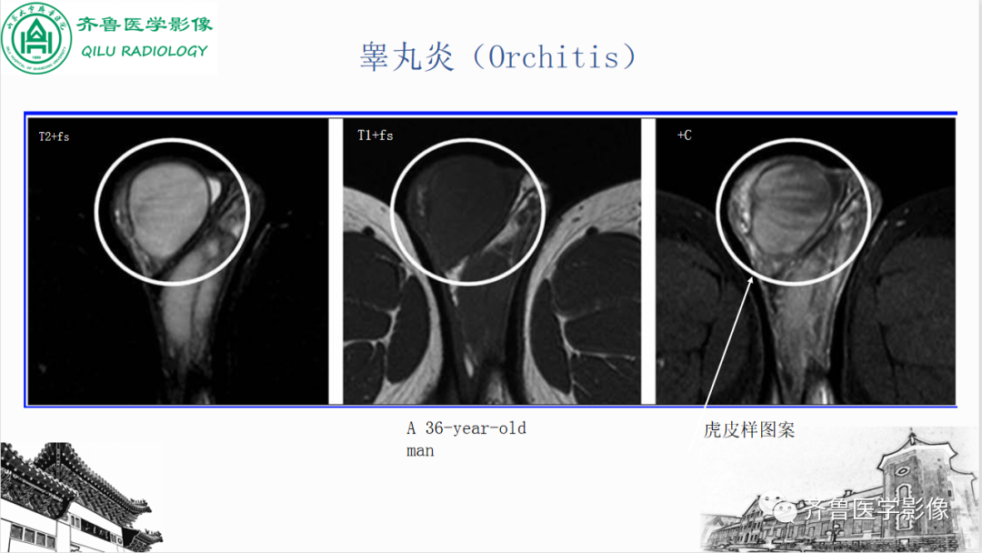 影像PPT - 【PPT】男性生殖系统疾病（睾丸扭转）-31